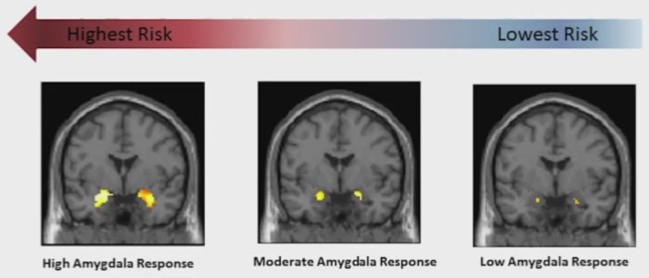 The higher your baseline amygdalar activation, the higher the risk to develop anxiety disorders later on if expossed to life stressors. Yellow = amygdala. Photo credit: https://www.youtube.com/watch?v=JD44PbAOTy8, presumably copyrighted to Duke University.